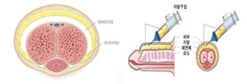 Penis Enlargement Surgery with autologous fat injection added